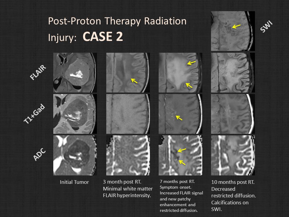 Post-Proton Therapy Radiation Injury: CASE 2 Initial Tumor 3 month post RT.