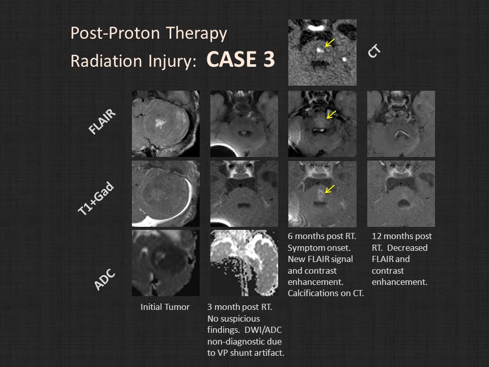 Post-Proton Therapy Radiation Injury: CASE 3 FLAIR T1+Gad ADC Initial Tumor 3 month post RT.