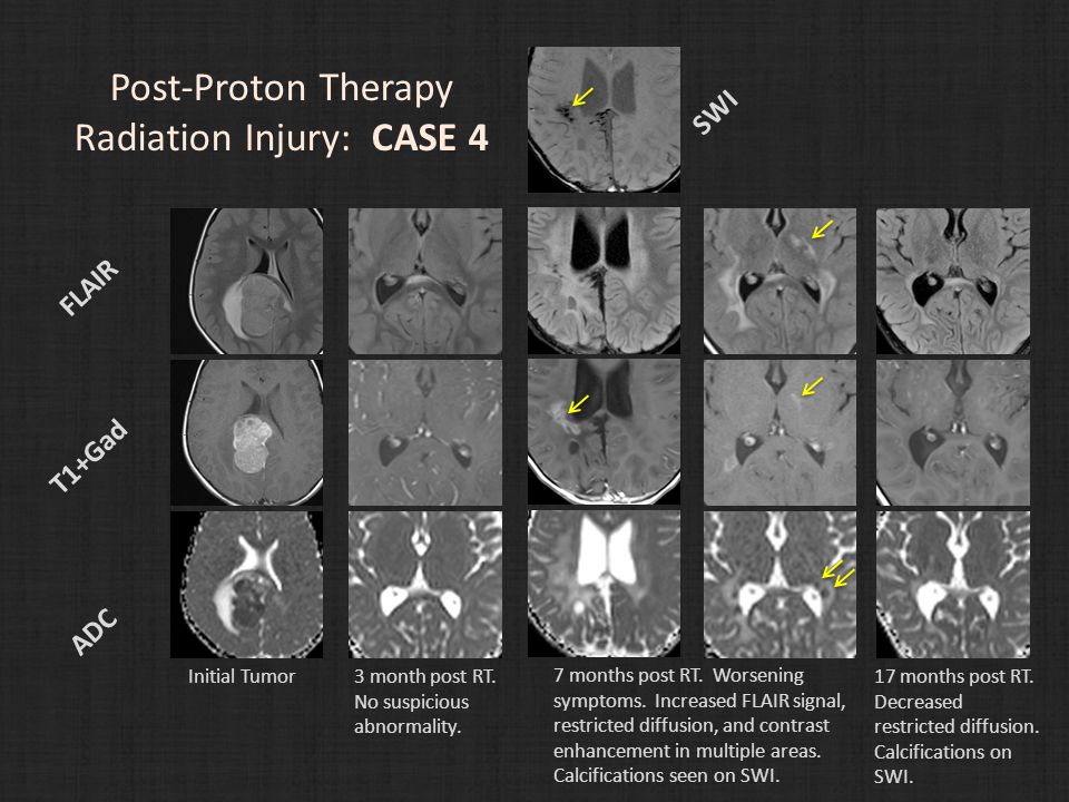 Post-Proton Therapy Radiation Injury: CASE 4 FLAIR T1+Gad ADC Initial Tumor3 month post RT.