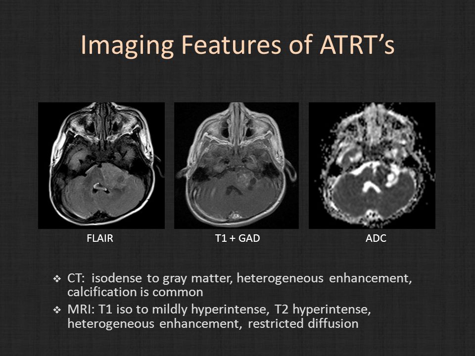 Imaging Features of ATRT’s  CT: isodense to gray matter, heterogeneous enhancement, calcification is common  MRI: T1 iso to mildly hyperintense, T2 hyperintense, heterogeneous enhancement, restricted diffusion FLAIRT1 + GADADC