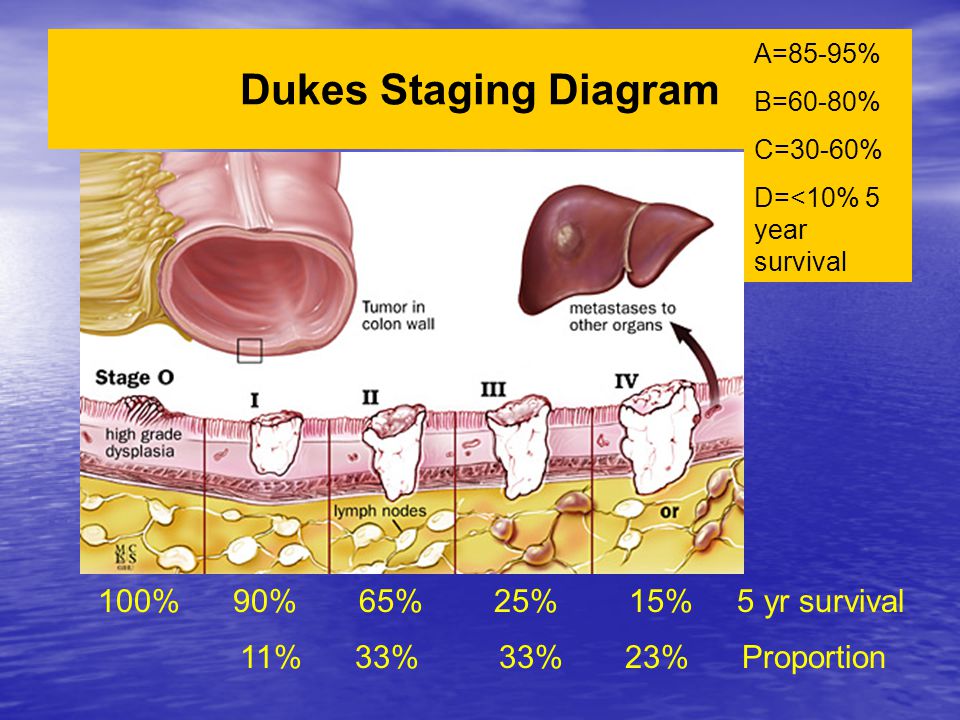 Dukes Staging Diagram 100% 90% 65% 25% 15% 5 yr survival 11% 33% 33% 23% Proportion A=85-95% B=60-80% C=30-60% D=<10% 5 year survival