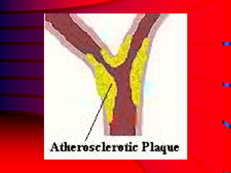 ARTERIOSCLEROSIS HARDENING OR THICKENING OF WALLS OF ARTERIES LOSS OF ELASTICITY AND CONTRACTILITY COMMONLY OCCURS AS RESULT OF AGING CAUSES HYPERTENSION –MAY LEAD TO ANEURYSM OR CEREBRAL HEMORRHAGE