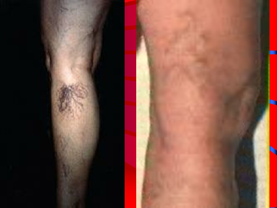 VARICOSE VEINS DILATED, SWOLLEN VEINS LOST ELASTICITY –CAUSE STASIS OR DECREASED BLOOD FLOW OCCUR REQUENTLY IN LEGS RESULT FROM –PREGNANCY –PROLONGED SITTING OR STANDING –HEREDITARY FACTORS