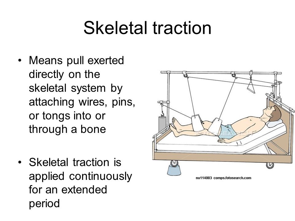 What is skeletal traction?