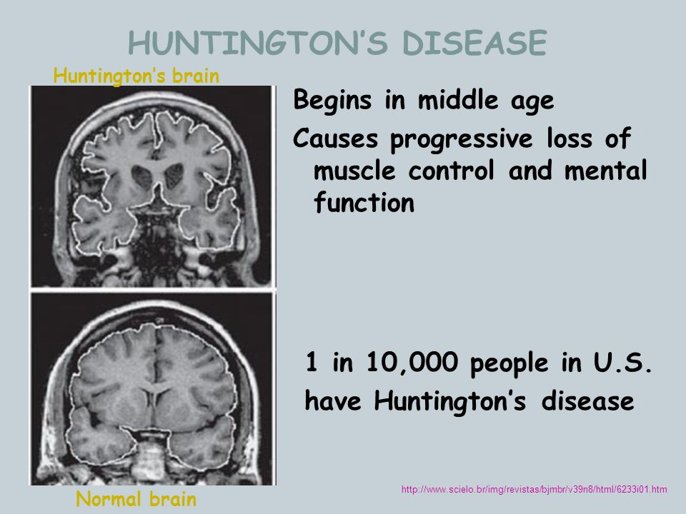 huntington’s disease huntington’s disease
