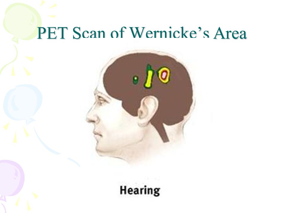 PET Scan of Wernicke’s Area