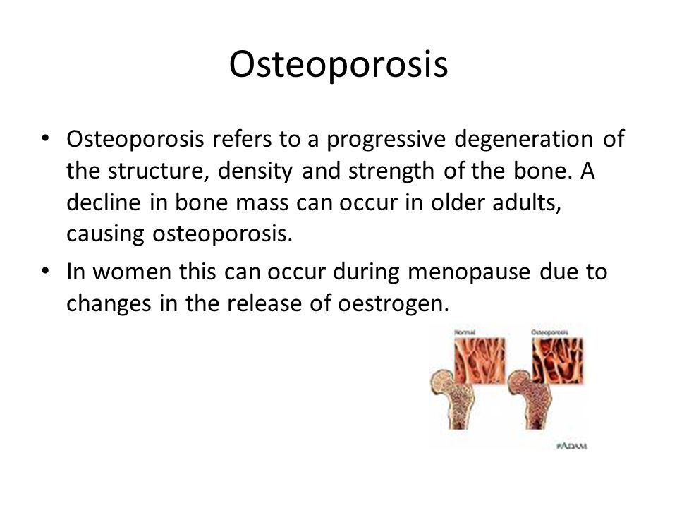 Osteoporosis refers to a progressive degeneration of the structure, density and strength of the bone.