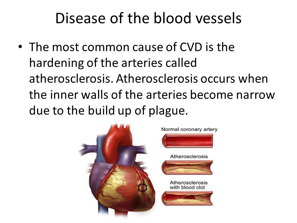 Disease of the blood vessels The most common cause of CVD is the hardening of the arteries called atherosclerosis.