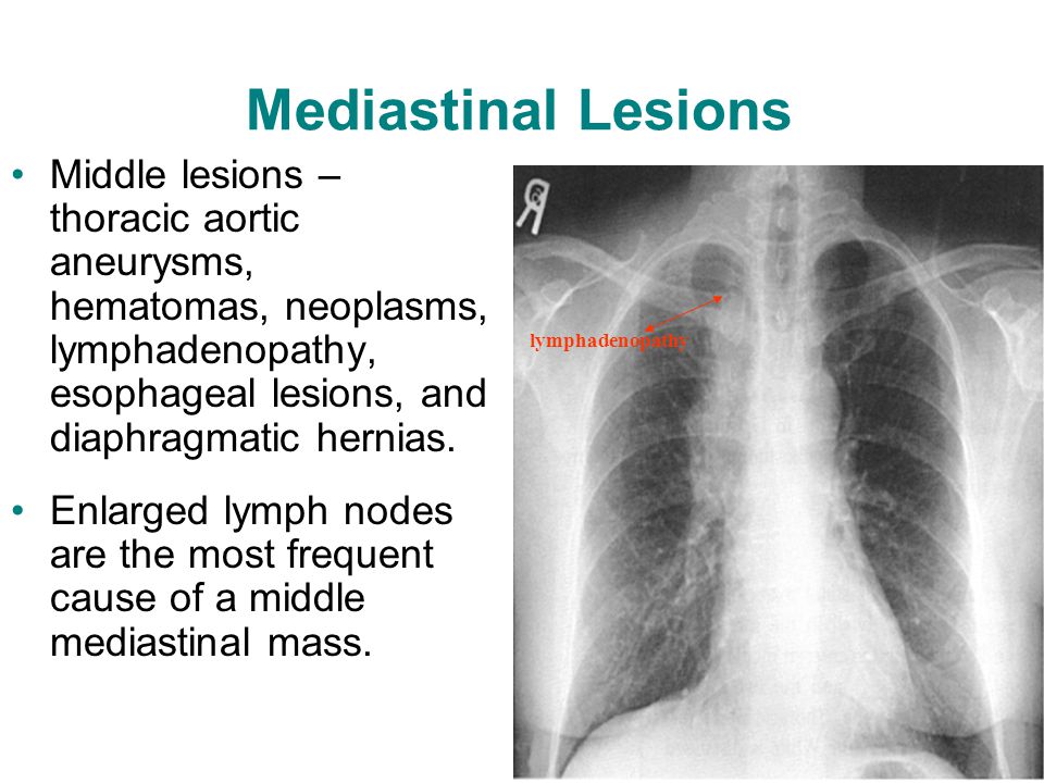 mediastinal lymph nodes