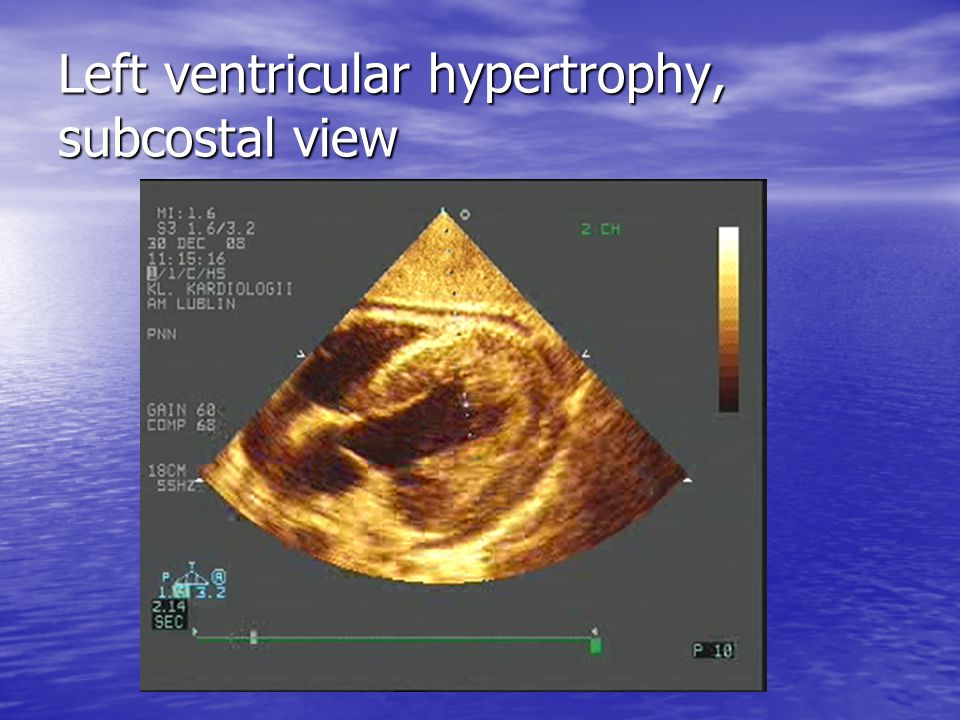 Left ventricular hypertrophy, subcostal view