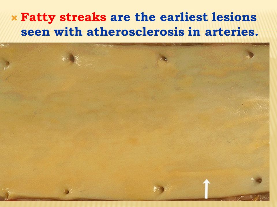  Fatty streaks are the earliest lesions seen with atherosclerosis in arteries.