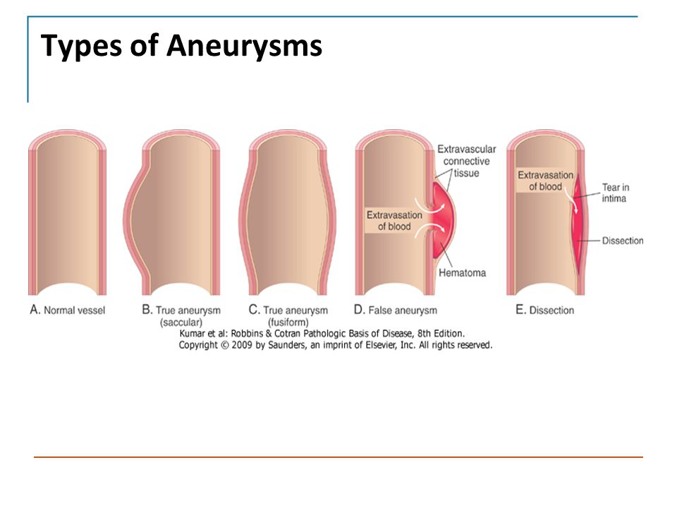 types of aneurysms