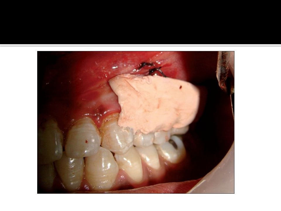 periodontal dressing