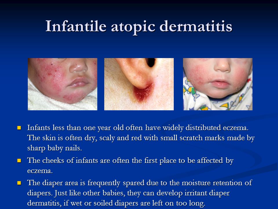 Atopic dermatitis slides