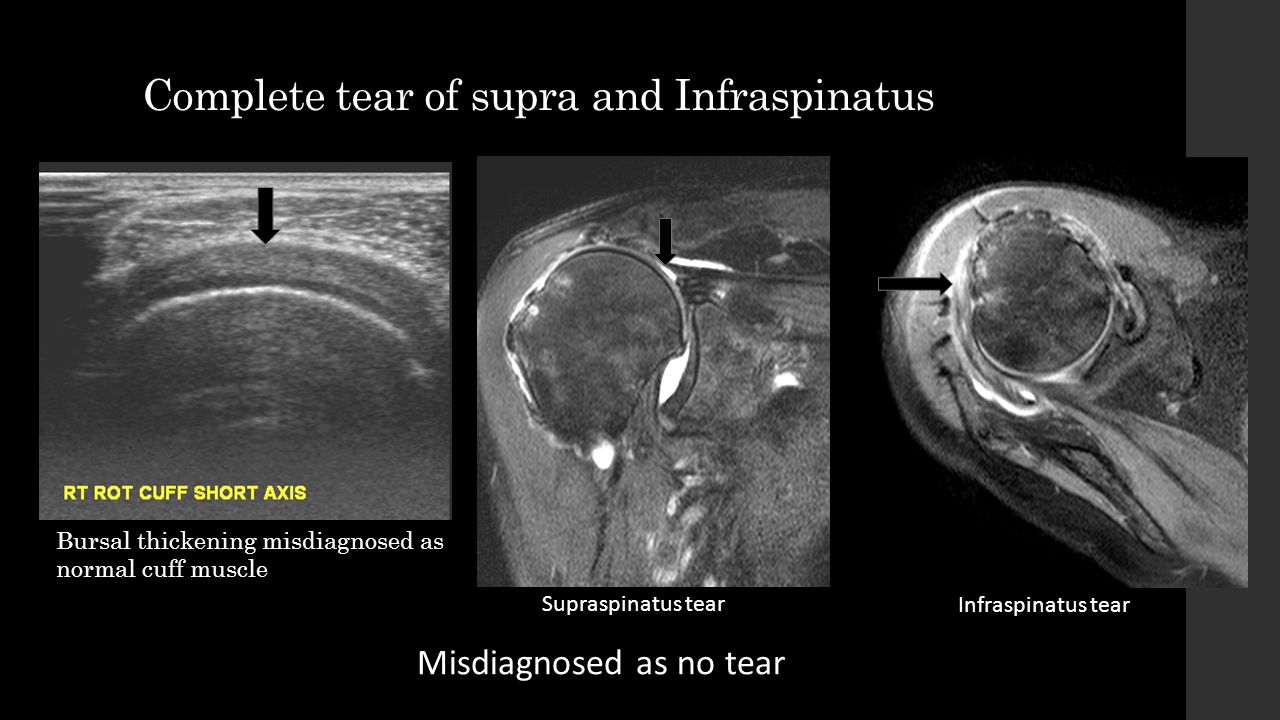 rotator cuff tear mri