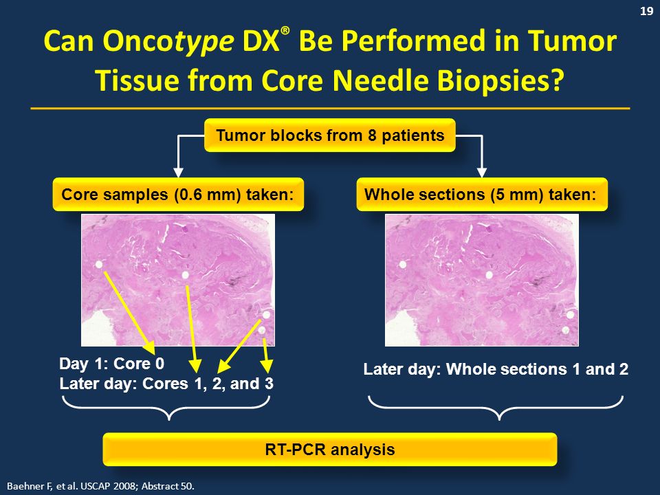 19 Can Oncotype DX ® Be Performed in Tumor Tissue from Core Needle Biopsies.