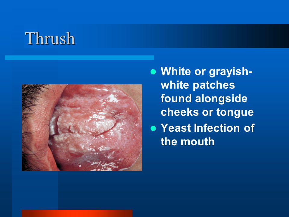 Thrush White or grayish- white patches found alongside cheeks or tongue Yeast Infection of the mouth