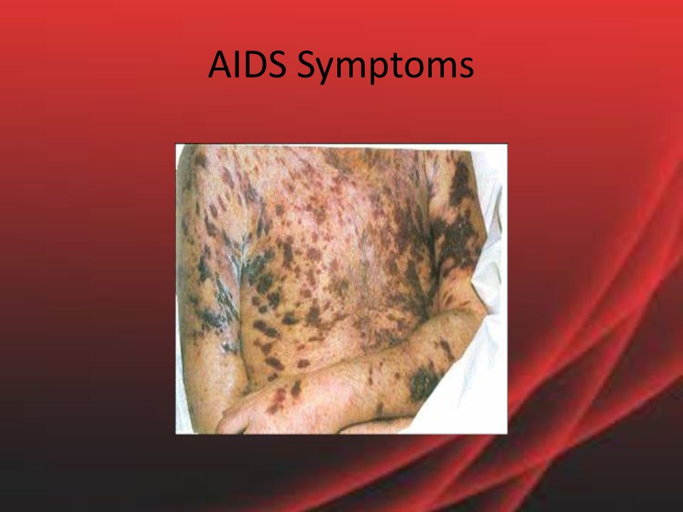 AIDS Symptoms