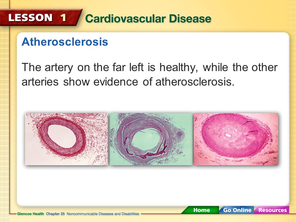 Atherosclerosis People with atherosclerosis have a condition called arteriosclerosis, which can cause a heart attack or stroke.