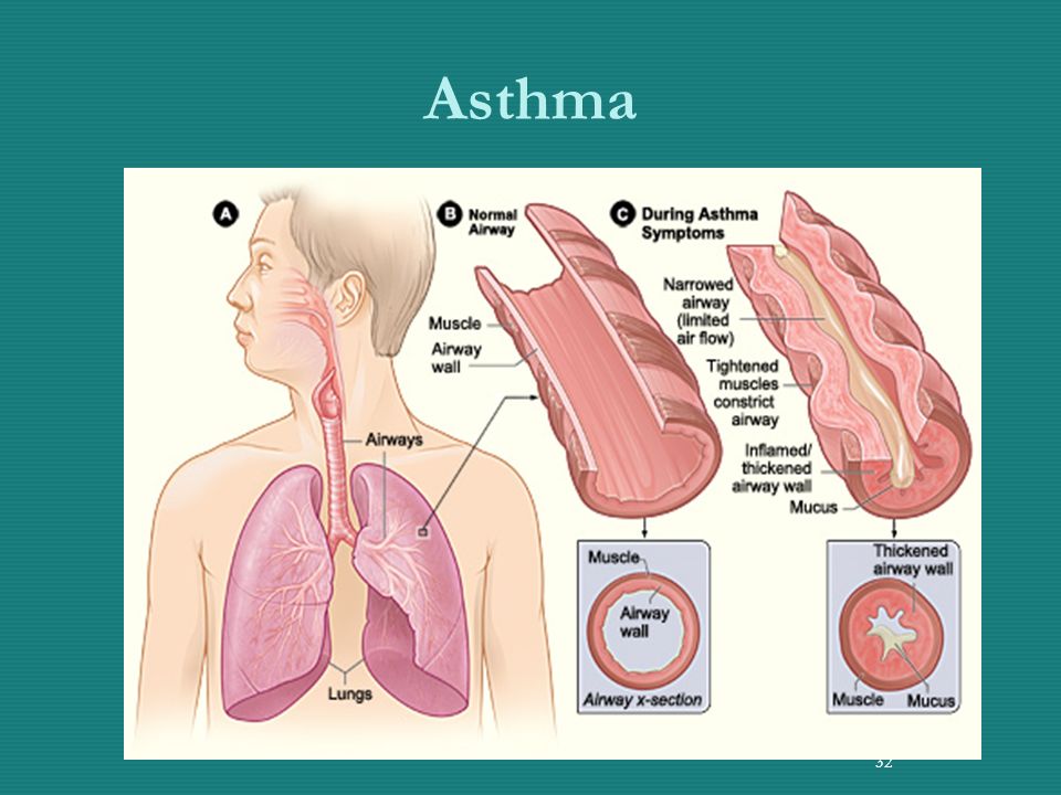 Asthma 32