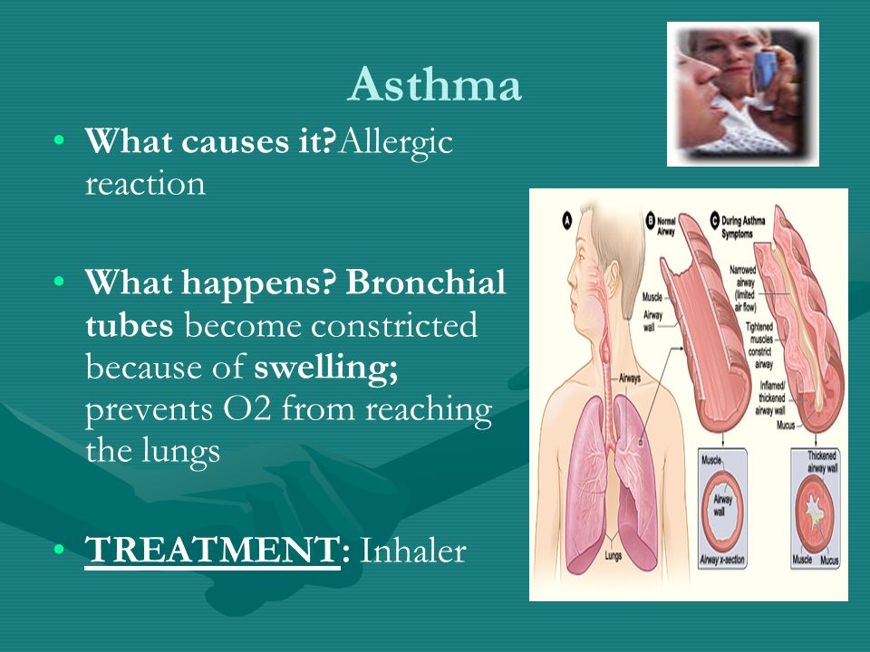 Asthma What causes it Allergic reaction What happens.
