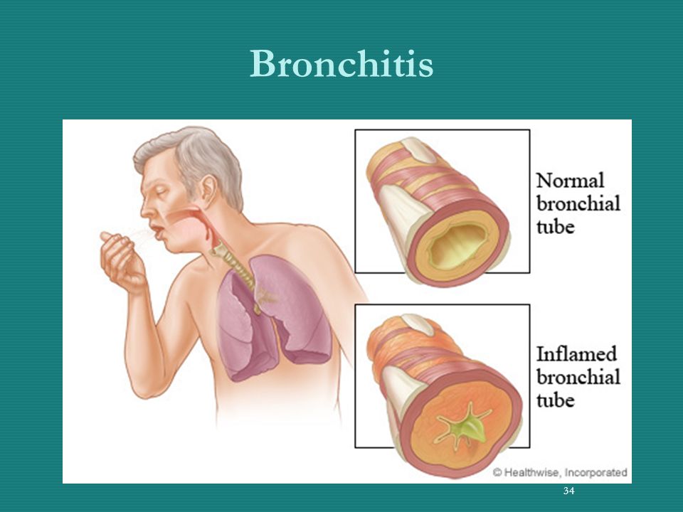 Bronchitis 34