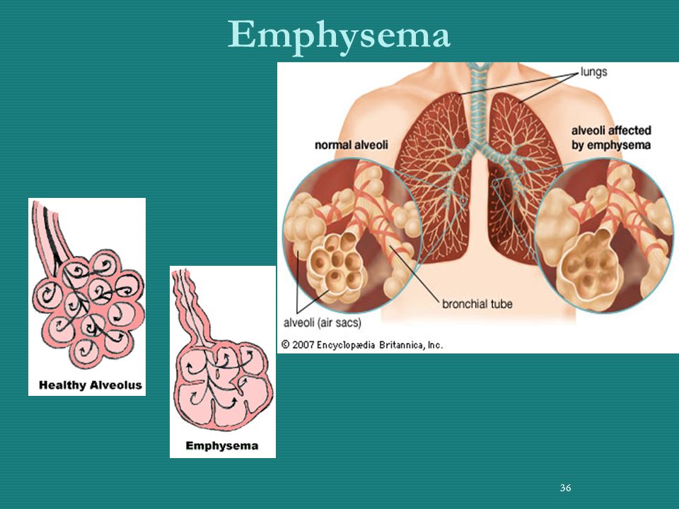Emphysema 36