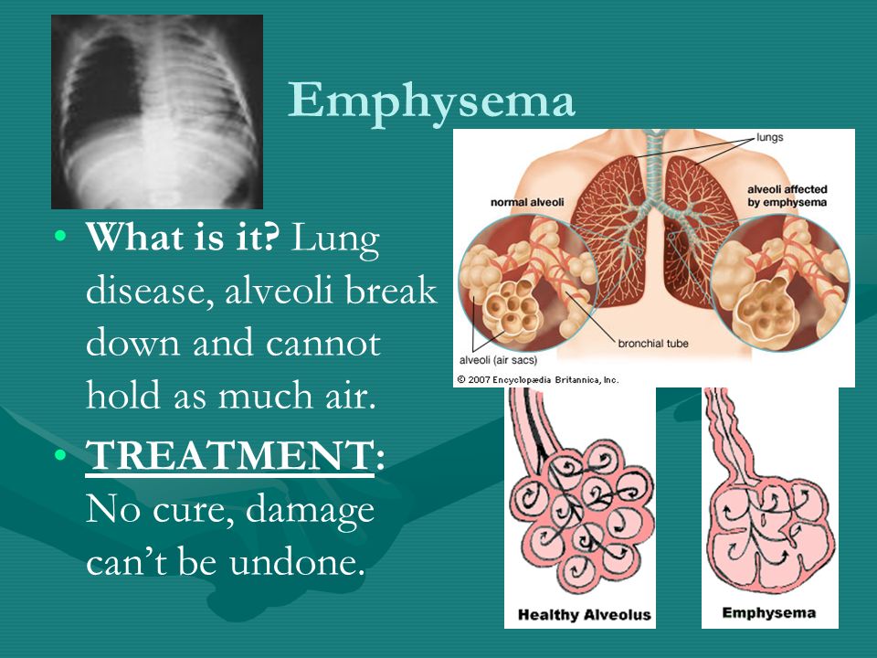 Emphysema What is it. Lung disease, alveoli break down and cannot hold as much air.