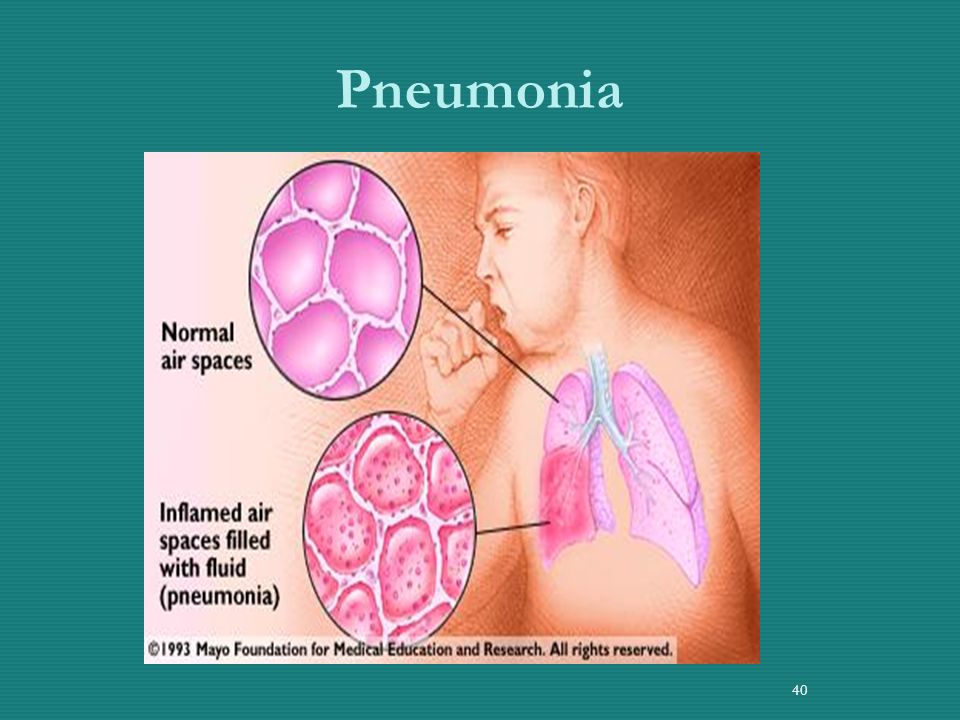 Pneumonia 40