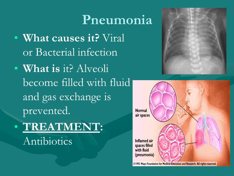 Pneumonia What causes it. Viral or Bacterial infection What is it.