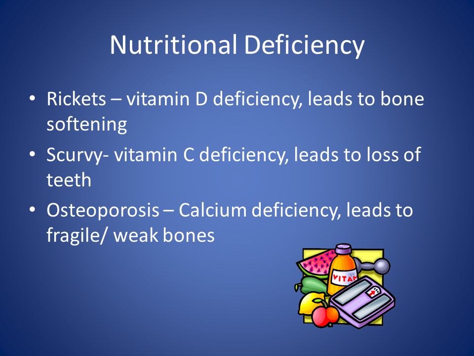 Nutritional Deficiency Rickets – vitamin D deficiency, leads to bone softening Scurvy- vitamin C deficiency, leads to loss of teeth Osteoporosis – Calcium deficiency, leads to fragile/ weak bones