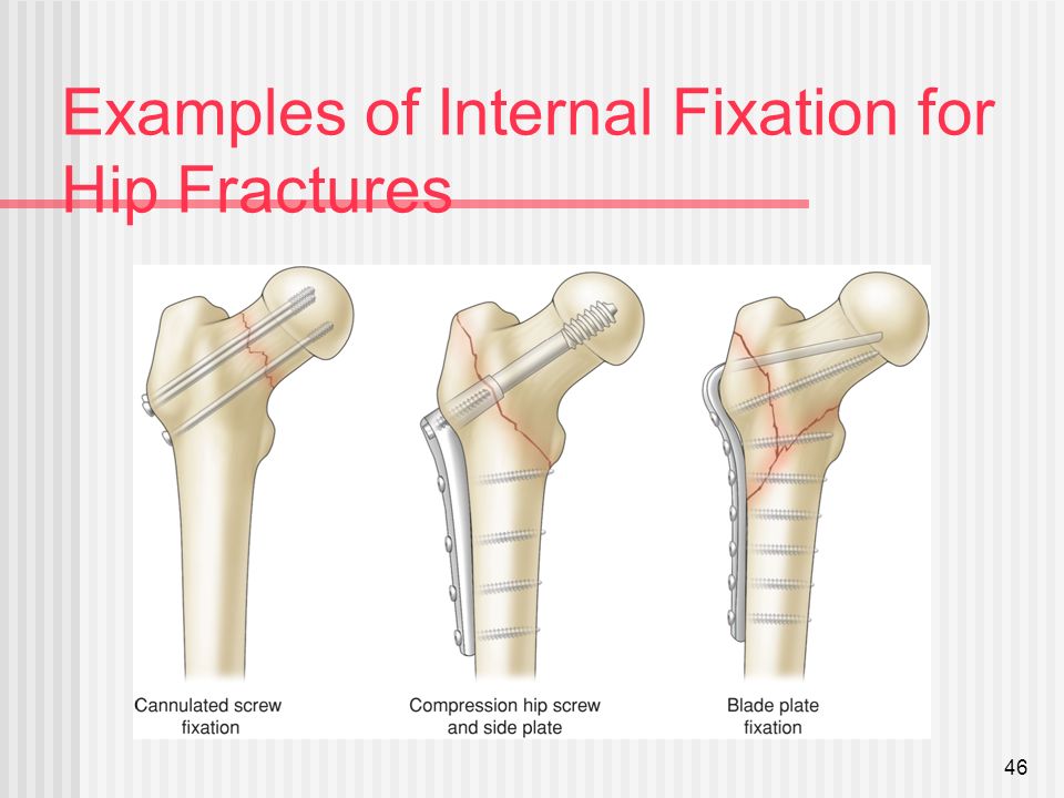hip fractures p2 ip hip fractures p2 ip