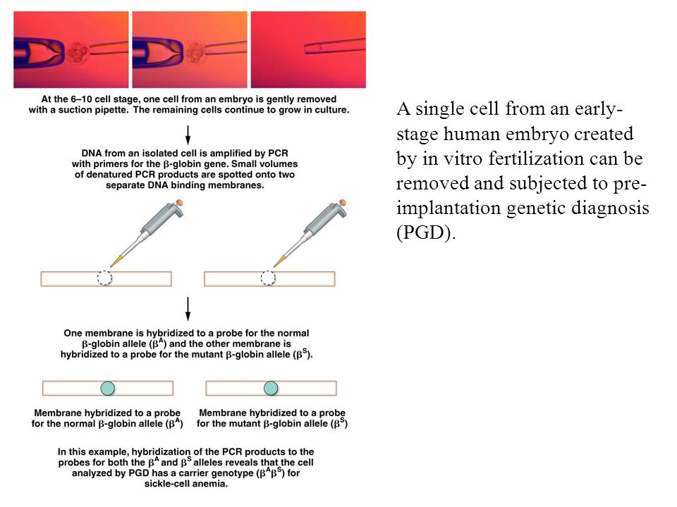 A single cell from an early- stage human embryo created by in vitro fertilization can be removed and subjected to pre- implantation genetic diagnosis (PGD).