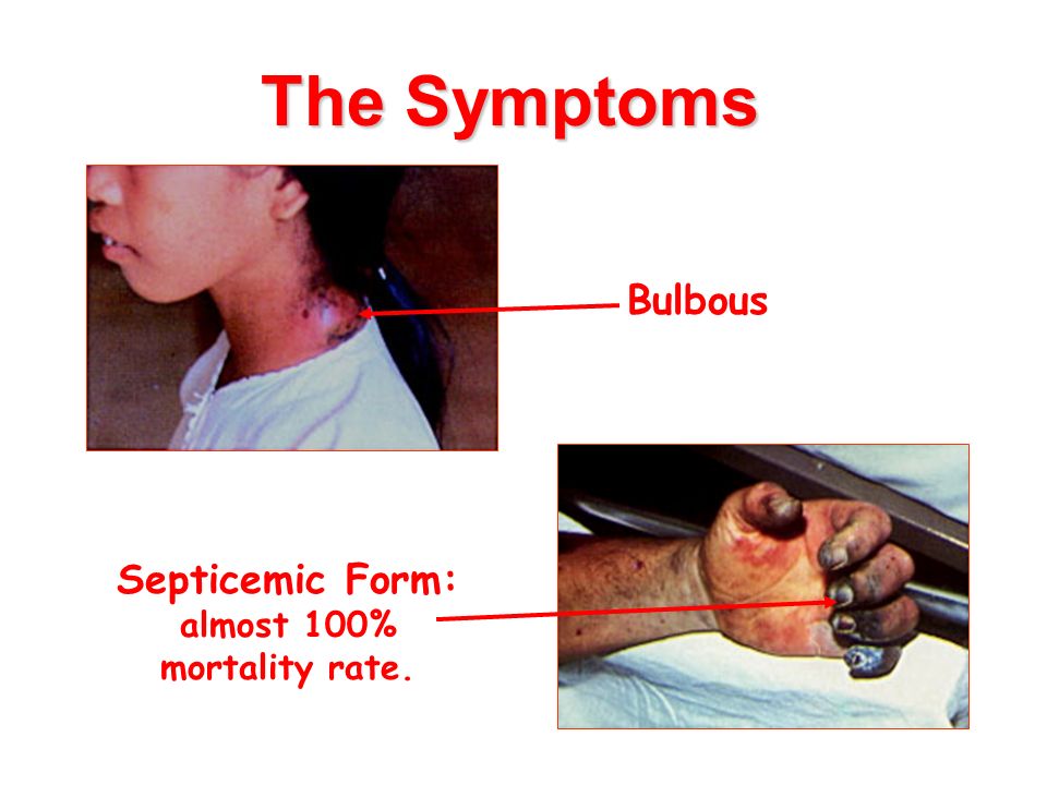 The Symptoms Bulbous Septicemic Form: almost 100% mortality rate.