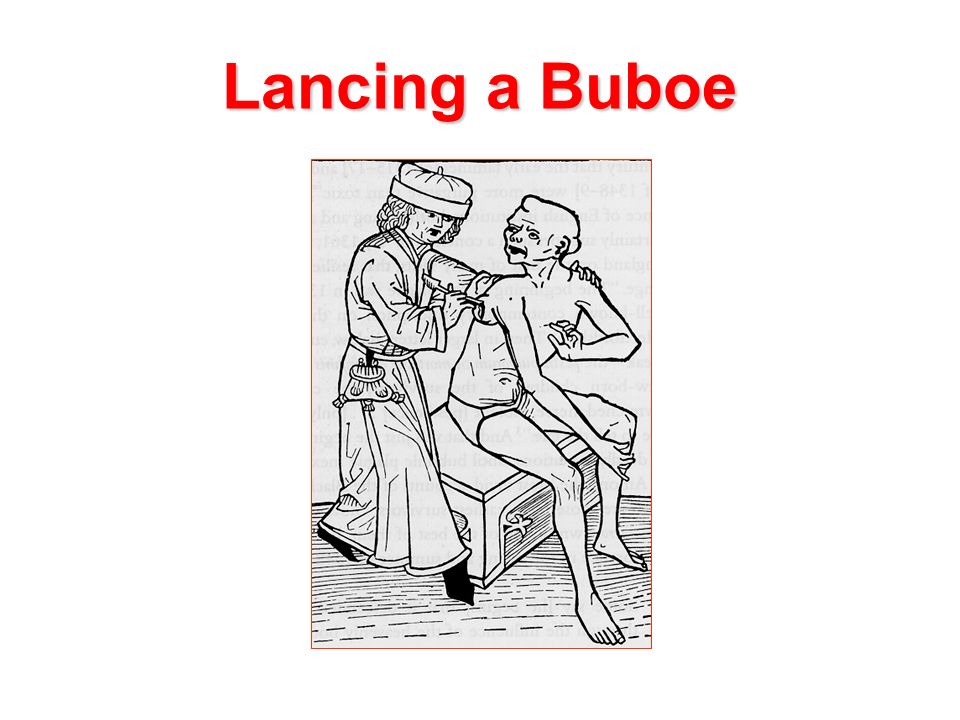 Lancing a Buboe