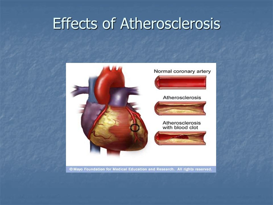 Effects of Atherosclerosis