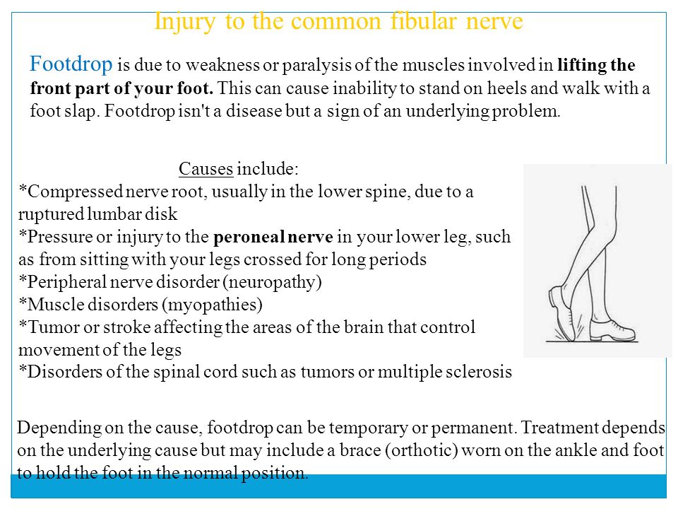 Sural nerve root tumor