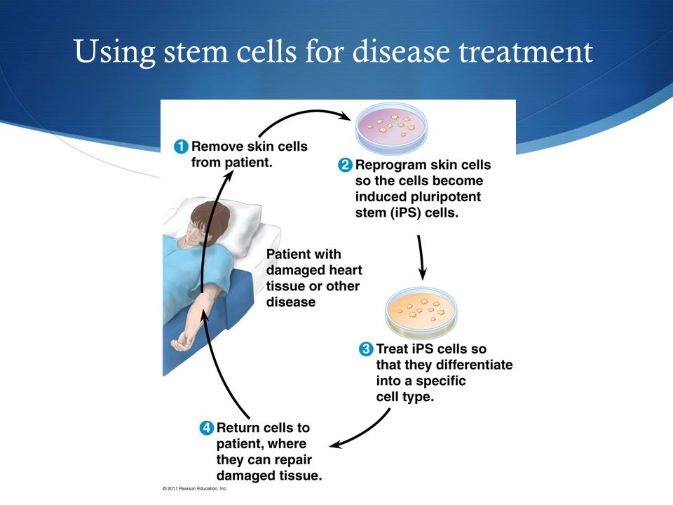 Using stem cells for disease treatment