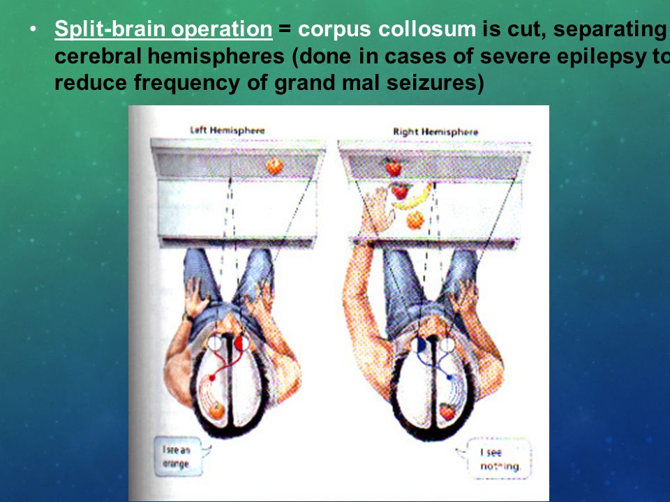 Split-brain operation = corpus collosum is cut, separating cerebral hemispheres (done in cases of severe epilepsy to reduce frequency of grand mal seizures)