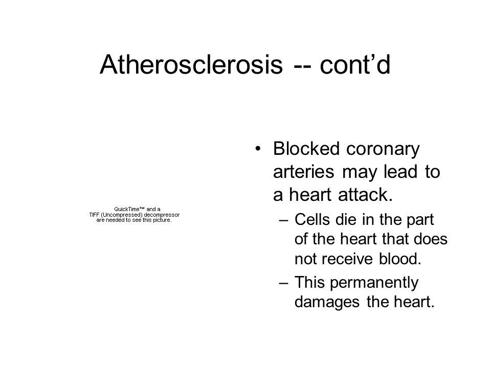 Atherosclerosis -- cont’d Blocked coronary arteries may lead to a heart attack.
