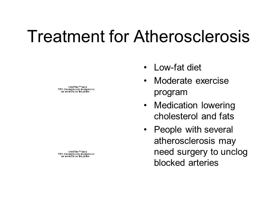 Treatment for Atherosclerosis Low-fat diet Moderate exercise program Medication lowering cholesterol and fats People with several atherosclerosis may need surgery to unclog blocked arteries