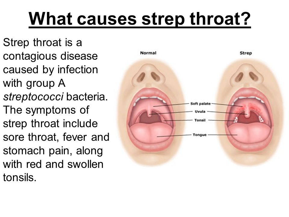 What causes strep throat.