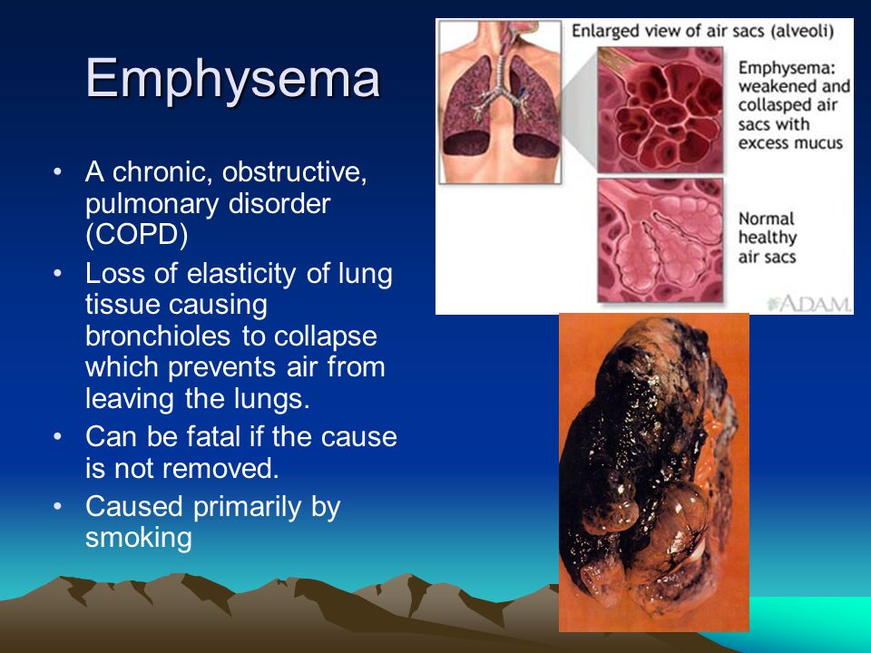 Emphysema A chronic, obstructive, pulmonary disorder (COPD) Loss of elasticity of lung tissue causing bronchioles to collapse which prevents air from leaving the lungs.