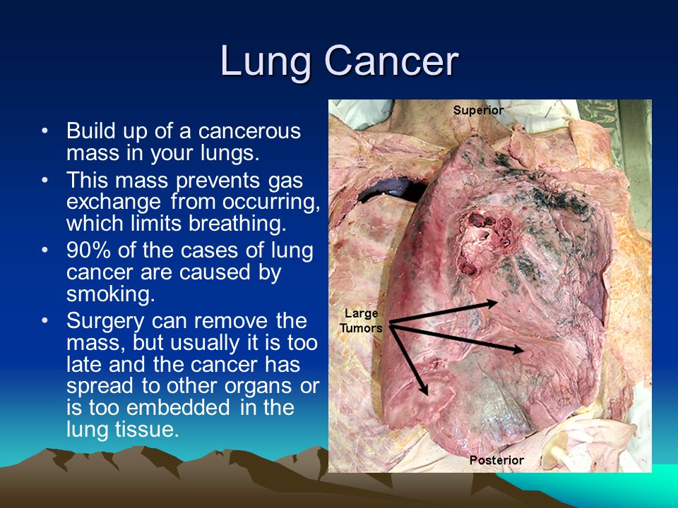 Lung Cancer Build up of a cancerous mass in your lungs.