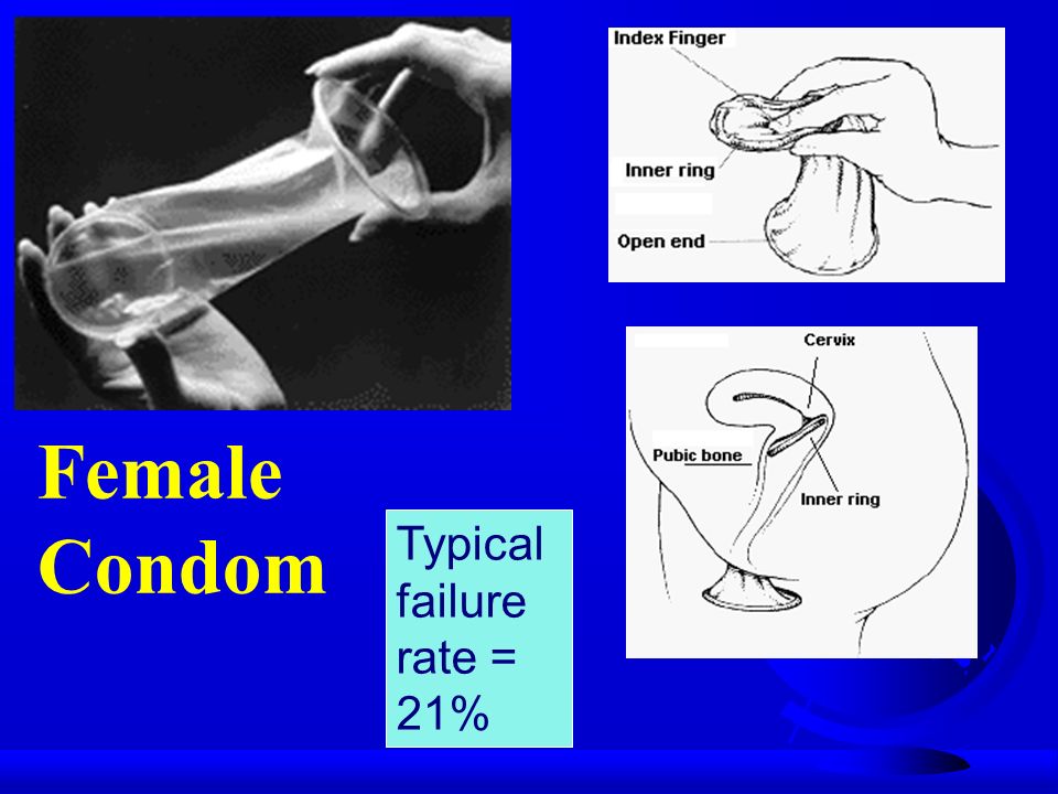 Female Condom Typical failure rate = 21%