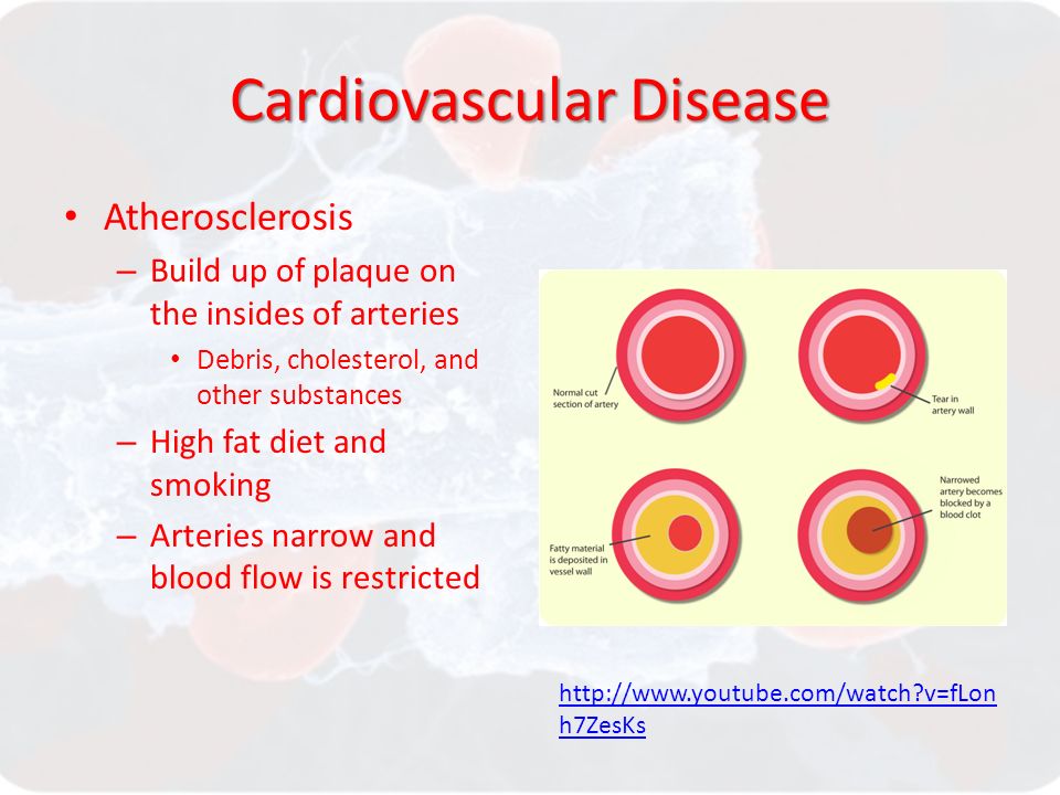 Cardiovascular Disease Atherosclerosis – Build up of plaque on the insides of arteries Debris, cholesterol, and other substances – High fat diet and smoking – Arteries narrow and blood flow is restricted   v=fLon h7ZesKs