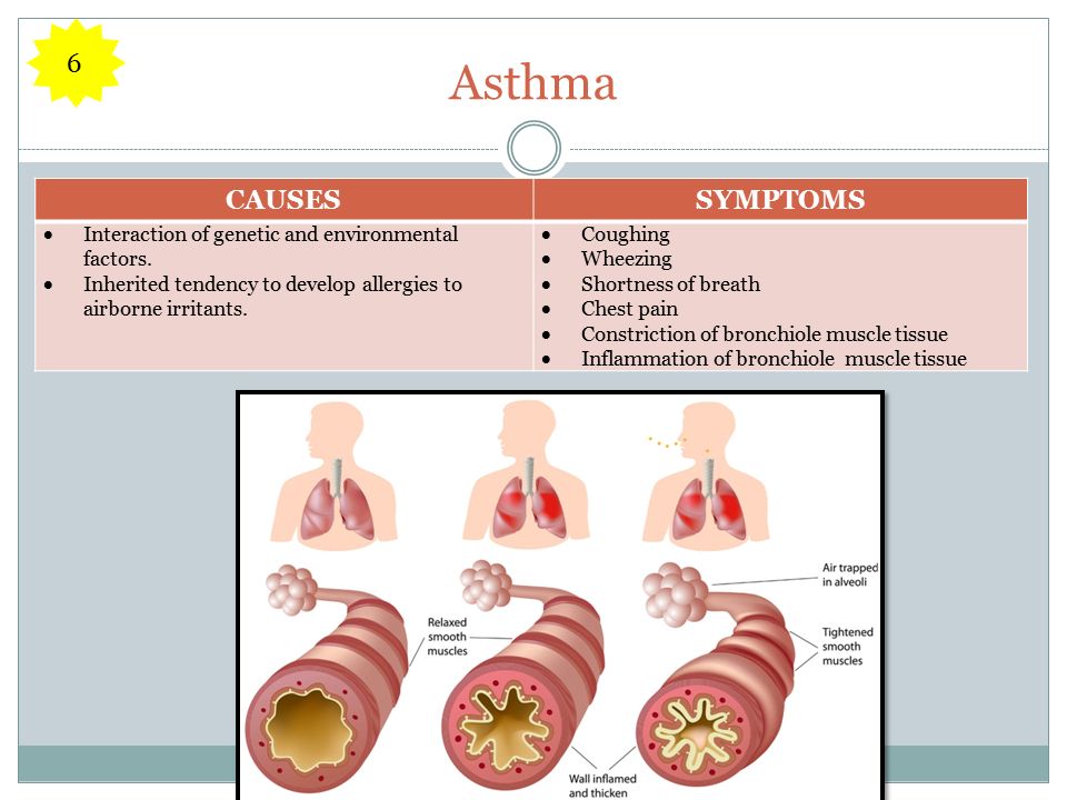 Asthma CAUSESSYMPTOMS  Interaction of genetic and environmental factors.