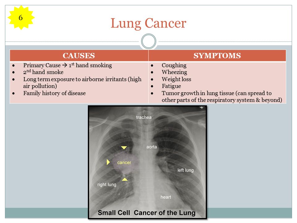 Lung Cancer CAUSESSYMPTOMS  Primary Cause  1 st hand smoking  2 nd hand smoke  Long term exposure to airborne irritants (high air pollution)  Family history of disease  Coughing  Wheezing  Weight loss  Fatigue  Tumor growth in lung tissue (can spread to other parts of the respiratory system & beyond) 6