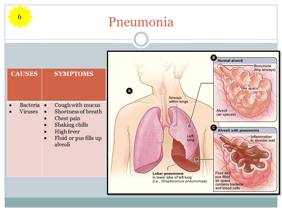 Pneumonia CAUSESSYMPTOMS  Bacteria  Viruses  Cough with mucus  Shortness of breath  Chest pain  Shaking chills  High fever  Fluid or pus fills up alveoli 6