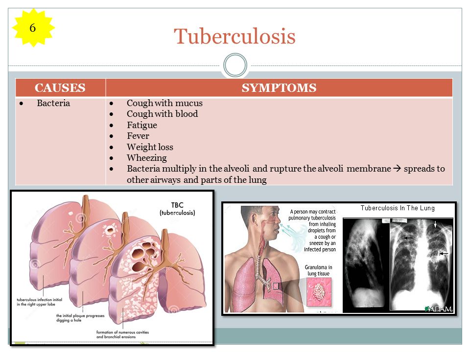 Tuberculosis CAUSESSYMPTOMS  Bacteria  Cough with mucus  Cough with blood  Fatigue  Fever  Weight loss  Wheezing  Bacteria multiply in the alveoli and rupture the alveoli membrane  spreads to other airways and parts of the lung 6